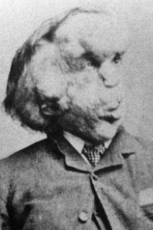 Joseph Merrick Image